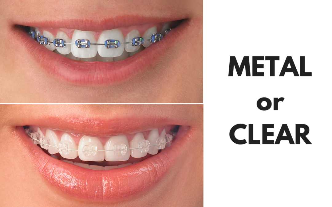 Ask Your El Campo Dentist: Should I Get Metal or Clear Braces?